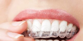 Aparatele dentare transparente intaresc increderea in sine