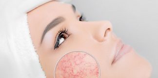 Toate lucrurile pe care incerca sa le spuna acneea ta despre sanatatea ta