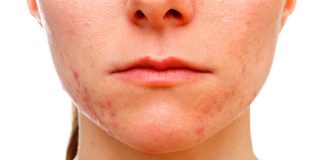 Alimente care agraveaza acneea