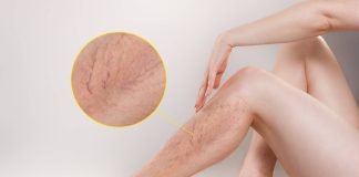 Cele mai bune 11 remedii pentru tratarea venelor varicoase